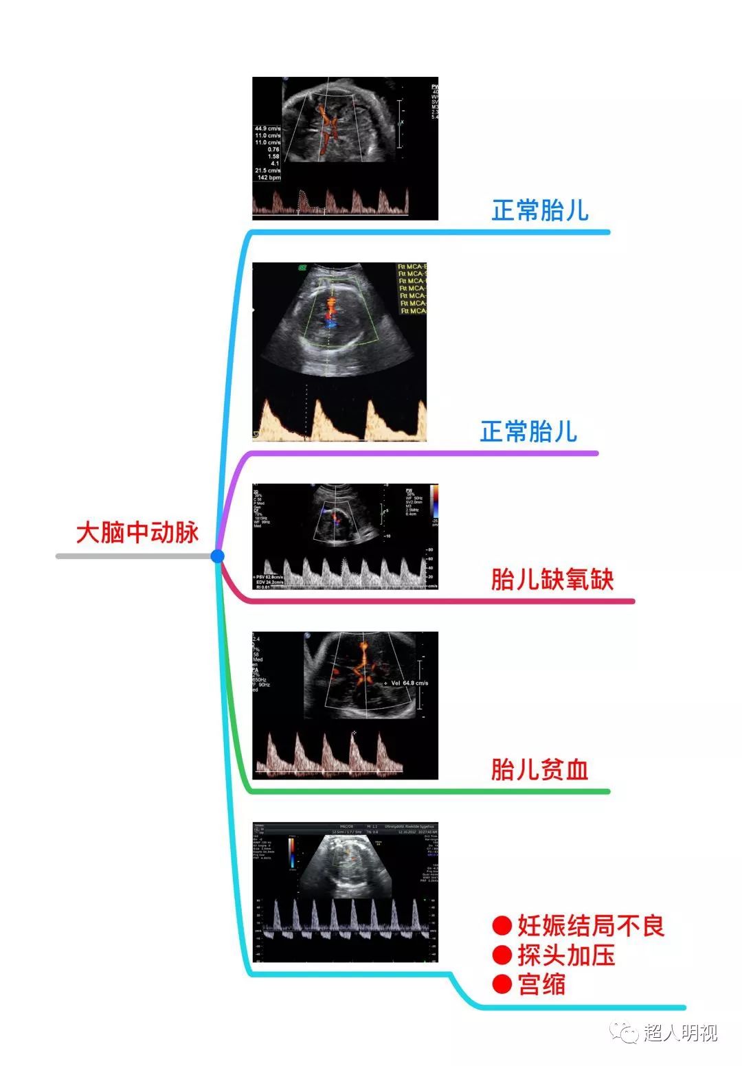 胎儿大脑中动脉psv75图片