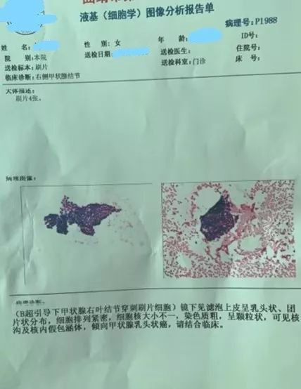 針尖上的藝術丨超聲引導下甲狀腺細針穿刺活檢術