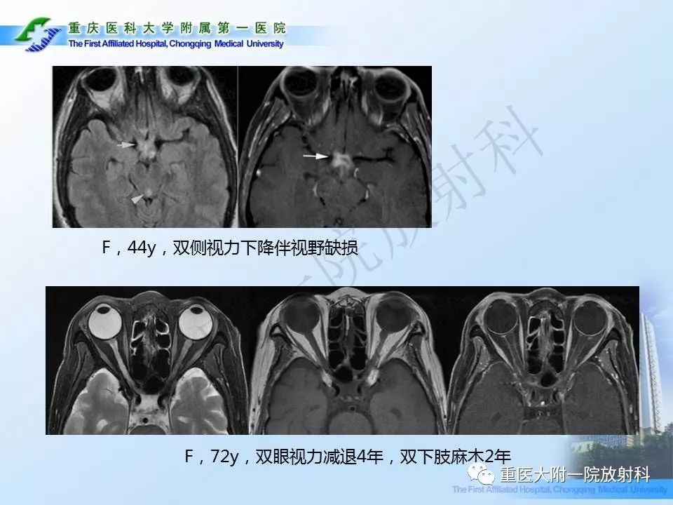 视神经脊髓炎临床及mri特征