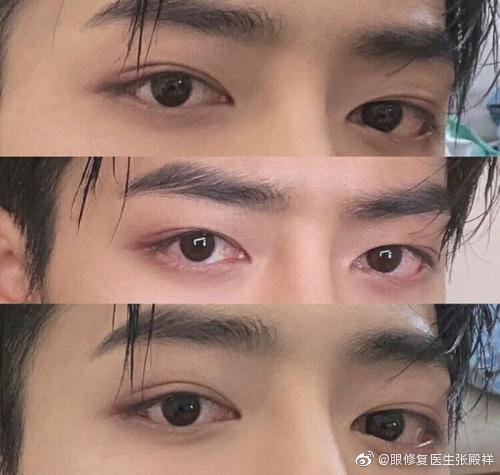 肖战是什么样的双眼皮呢