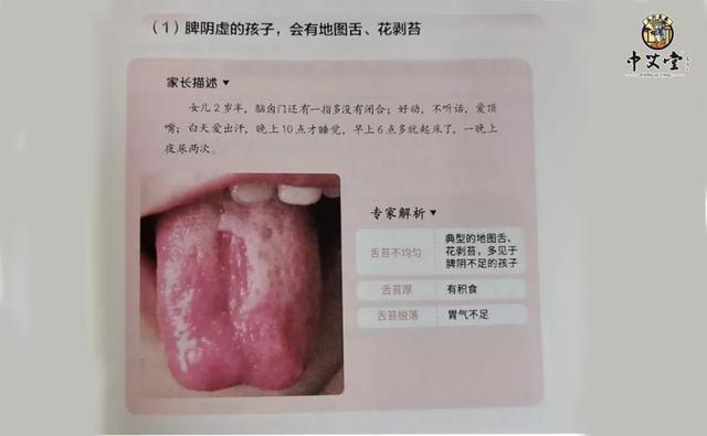 有个直观的表现就是地图舌,如图所示.