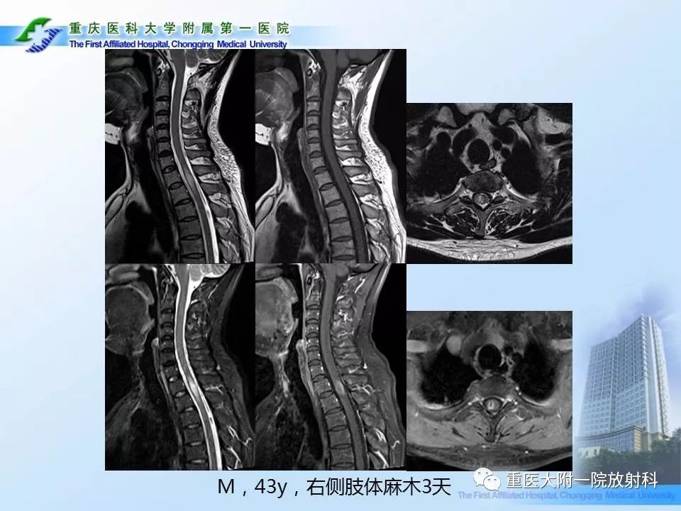 视神经脊髓炎临床及mri特征