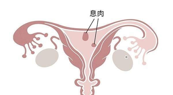 子宮有排除異物的傾向,使增生的黏膜逐漸自基底部向宮頸外口突出而