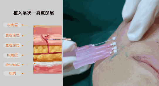 爆炸线能填充哪些地方谁能告知线雕爆炸线什么意思