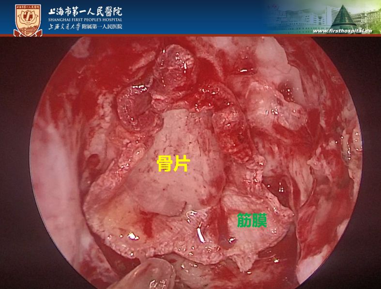 術前,術後24h影像顯示血腫完全清除.電腦端觀看鏈接https://www.