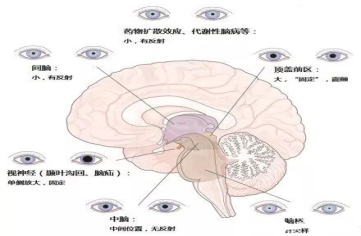 ⑴小脑幕切迹疝:患侧动眼神经受刺激→患侧瞳孔缩小,对光反射迟钝