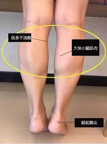 艺龄申洋肉毒素瘦小腿是否真的有效