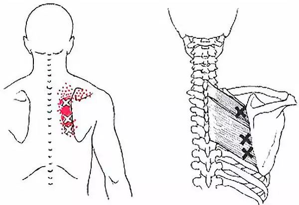 例二:提肩胛肌以及菱形肌过度的作用,会导致肩胛骨下旋症状.
