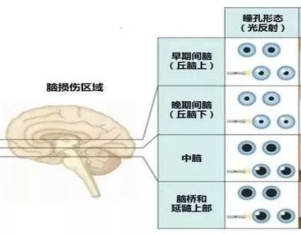 定位,根据瞳孔变化可初步确定病变部位三,观察瞳孔变化的临床意义6