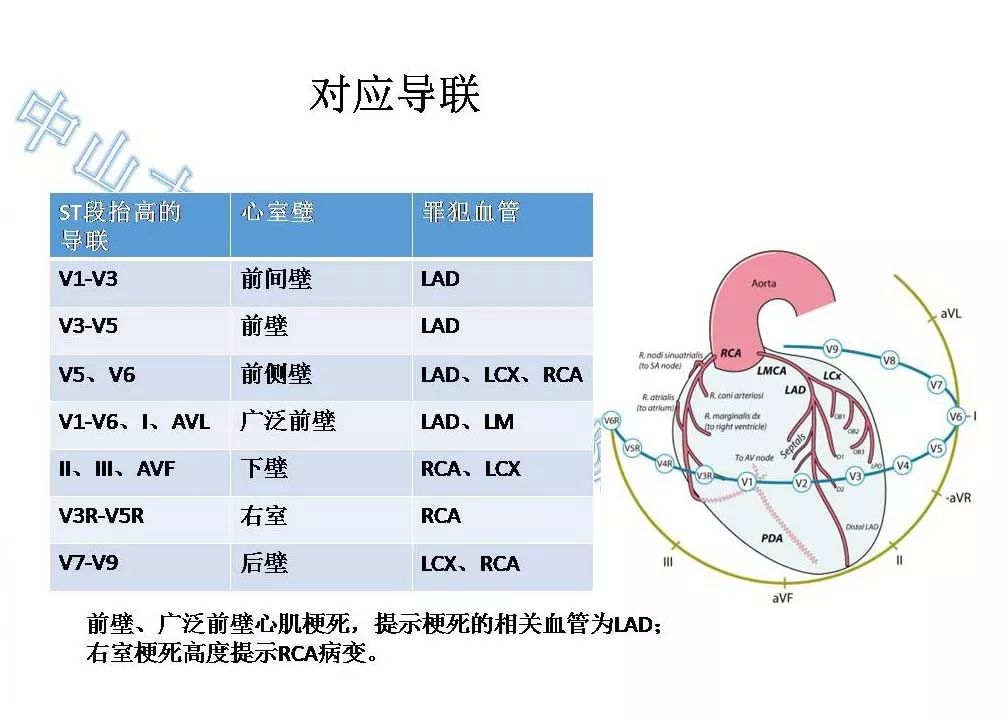 心肌梗死位置记忆图图片