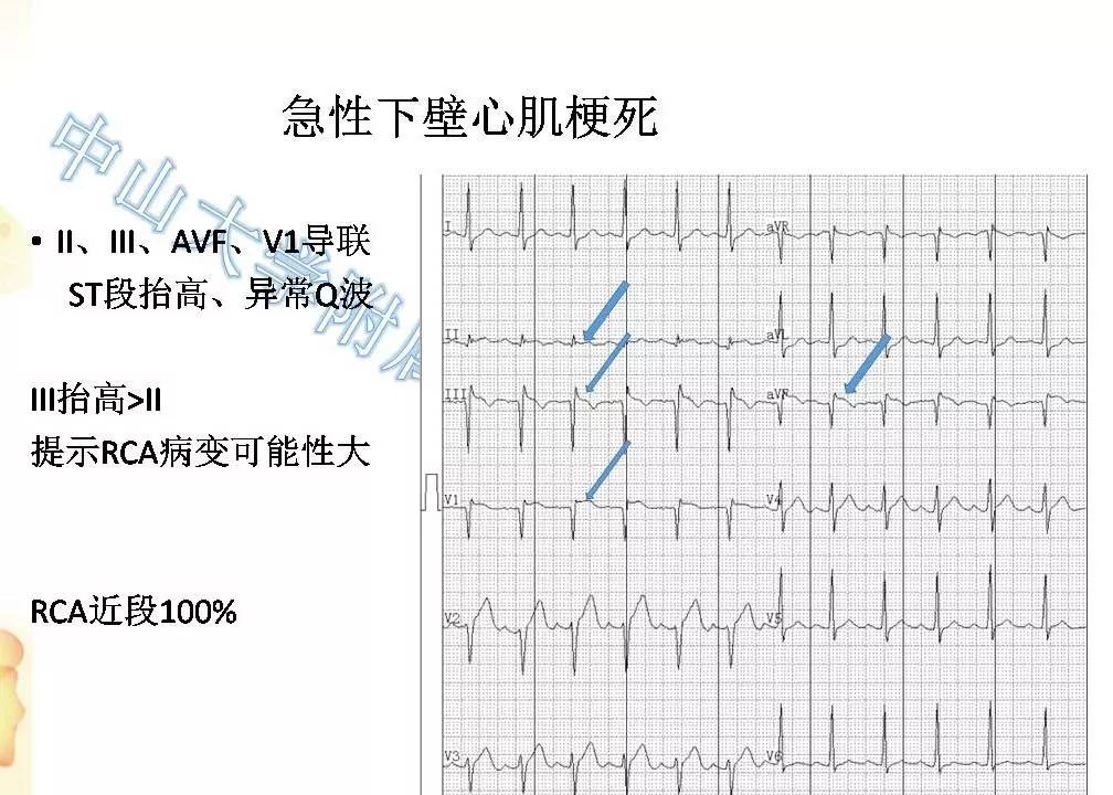 急性心肌梗死的心电图改变