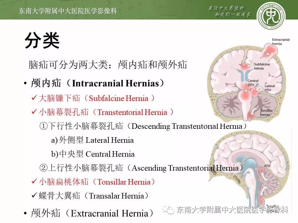 小脑扁桃体下疝畸形(病例3)右侧岛颞叶出血伴小脑幕切迹疝(病例2)右侧