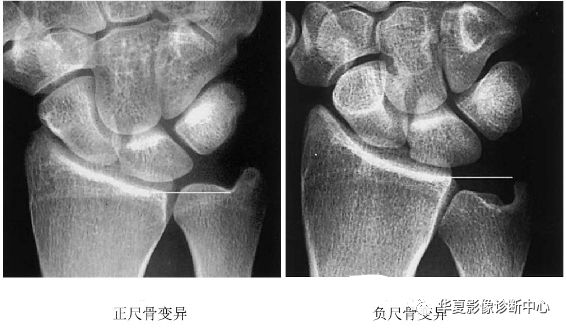 影像基础尺腕撞击综合征影像表现