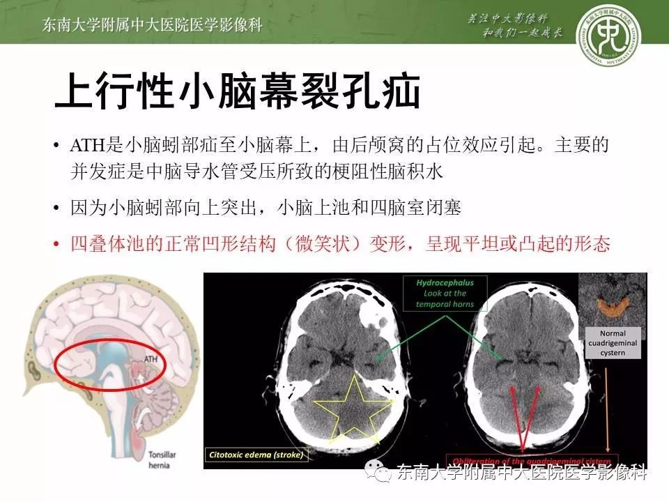 小脑扁桃体下疝畸形(病例3)右侧岛颞叶出血伴小脑幕切迹疝(病例2)右侧