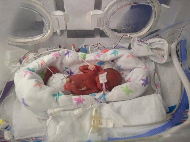 迷你奇迹:世界上最小的双胞胎男孩,出生23周后只有一瓶水那么重