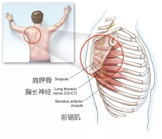 蝴蝶骨翼状肩手支撑肩胛骨突起这组肌群尤其要注意啦