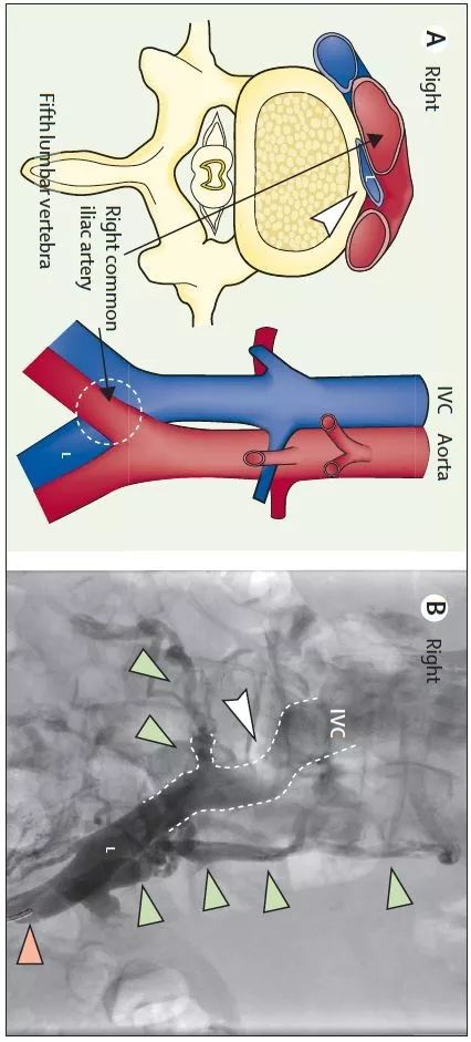 67为什么应避免左下肢静脉输液
