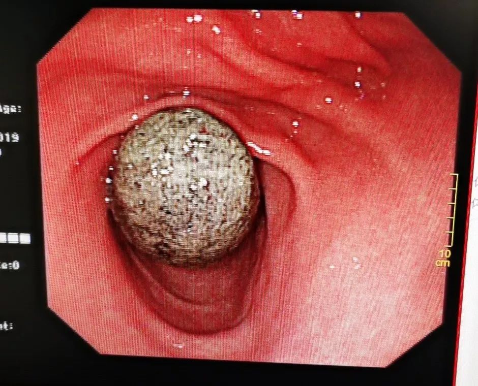 柘城一女士胃里长了两块巨大石头警惕生活中的这个习惯