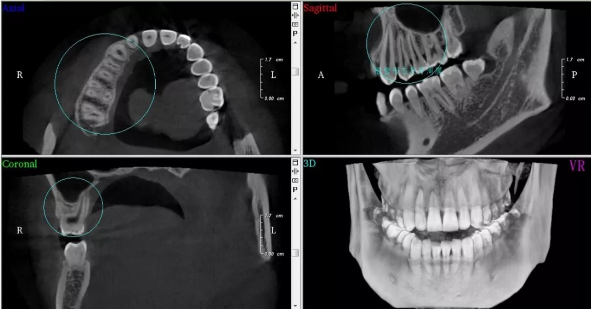 这些口腔疾病如果不用口腔ct拍片进行治疗的话后果严重到你难以想象