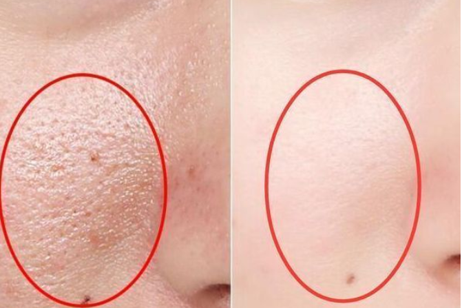 感染螨虫,皮肤会出现什么表现?原来长痘也有它的"功劳"