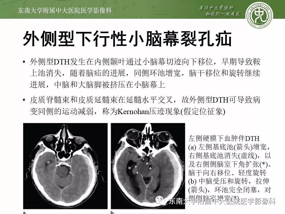 小脑扁桃体下疝畸形(病例3)右侧岛颞叶出血伴小脑幕切迹疝(病例2)右侧