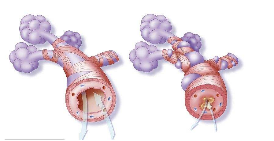 支气管哮喘会引起这些并发症,你知道吗?_病人