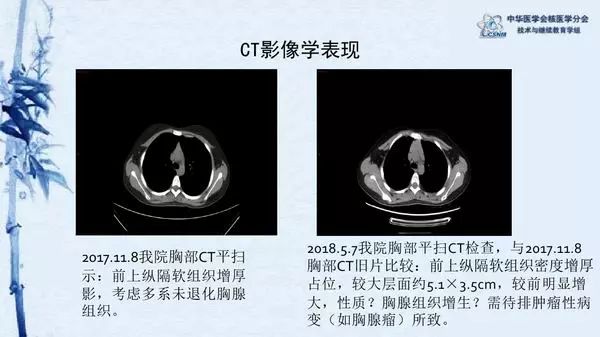 病例60期程祝忠化疗后胸腺增生petct显像一例