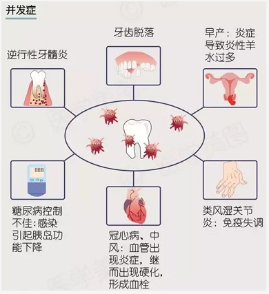 牙周炎是最常见的口腔疾病之一,也是成年人掉牙的"头号杀手".