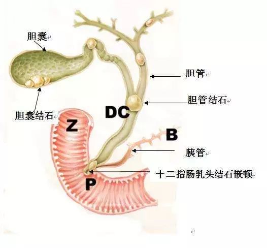 如果说放任结石不管,那如果是小的结石,它就有可能卡到胆囊颈部,引发
