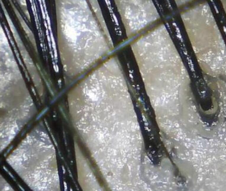 头皮经常瘙痒难耐隔天就变得很油腻还抠出白泥原来是这原因