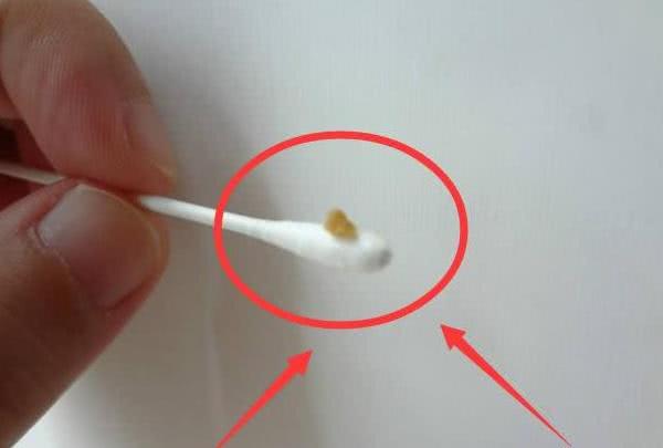 而若是你的耳朵内的油脂的分泌比较少的话