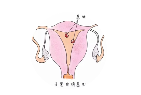 宫颈息肉卡通图片图片