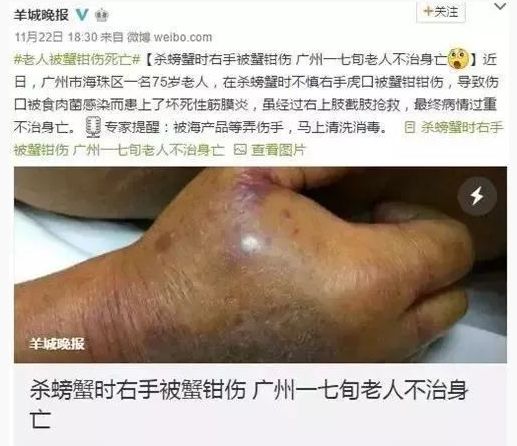 人体被"食肉菌"感染,也称坏死性筋膜炎,是一种非常罕见的感染性疾病,"