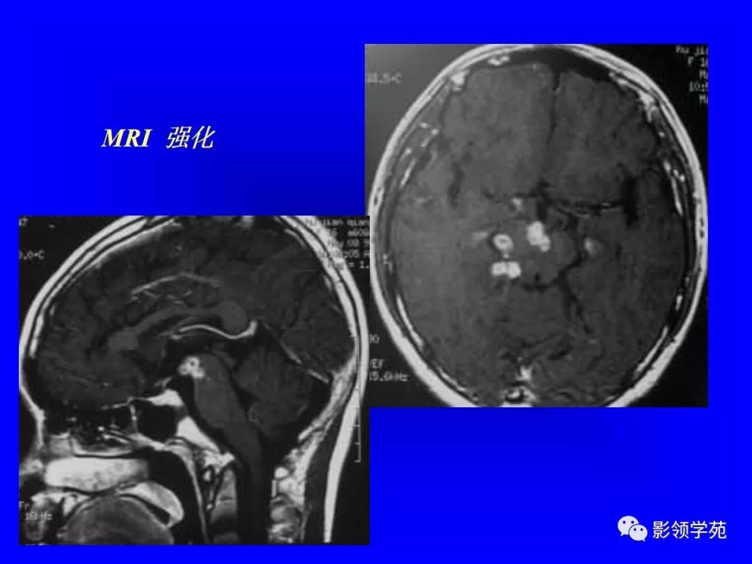 顱內多髮結節性病變的鑑別診斷