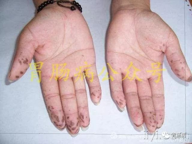 嘴上,手上长黑斑,胃里,肠里长息肉——这种遗传病易癌变