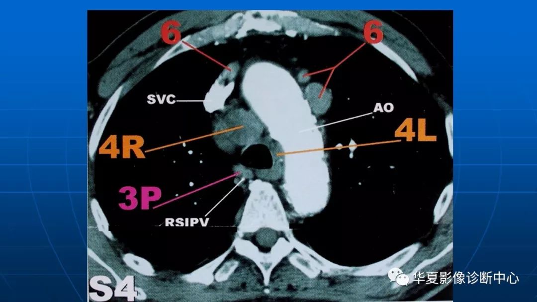 肺癌分期纵隔淋巴转移ct展示
