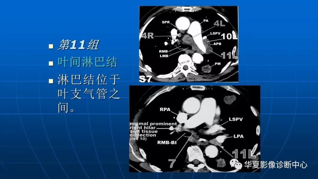 肺癌分期縱隔淋巴轉移ct展示