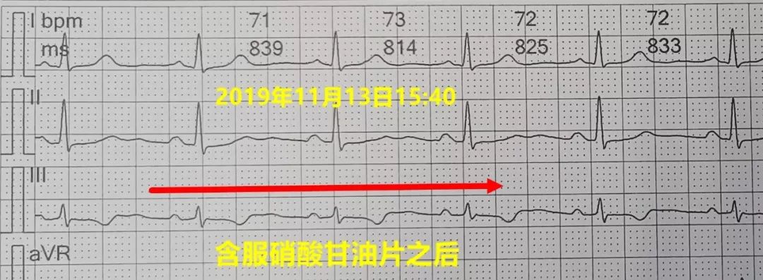 大活人心電圖怎麼變平了?_直線