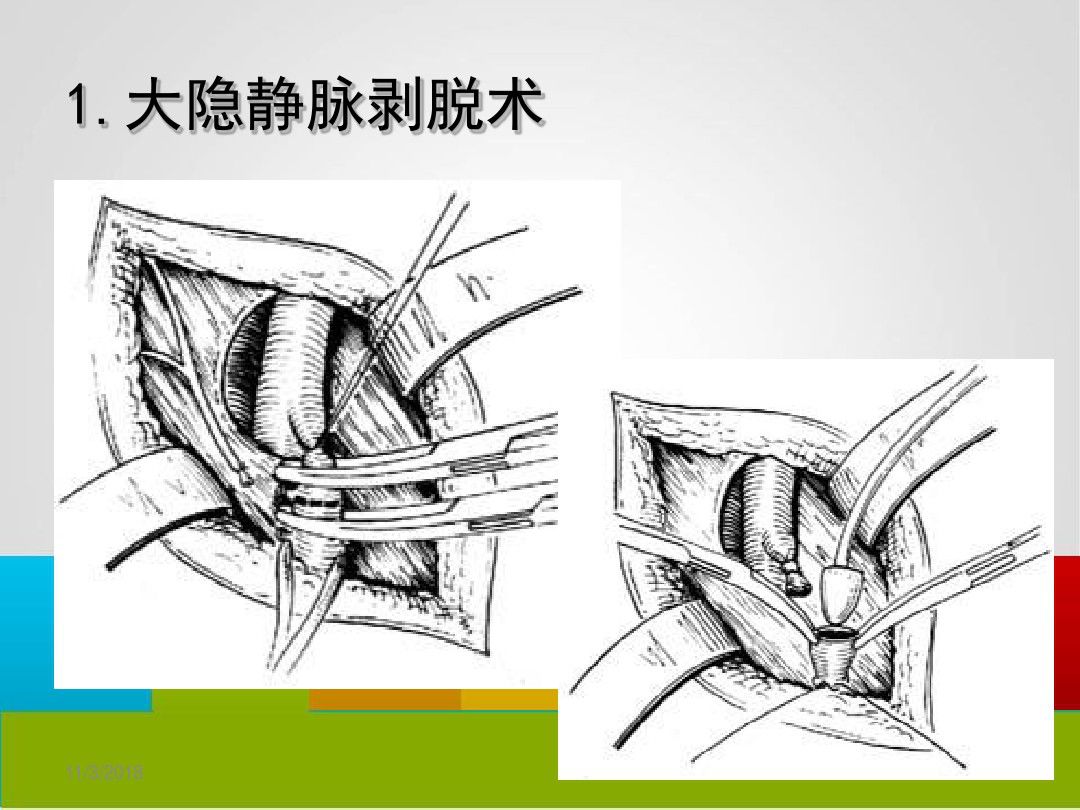 下肢静脉曲张手术图解图片