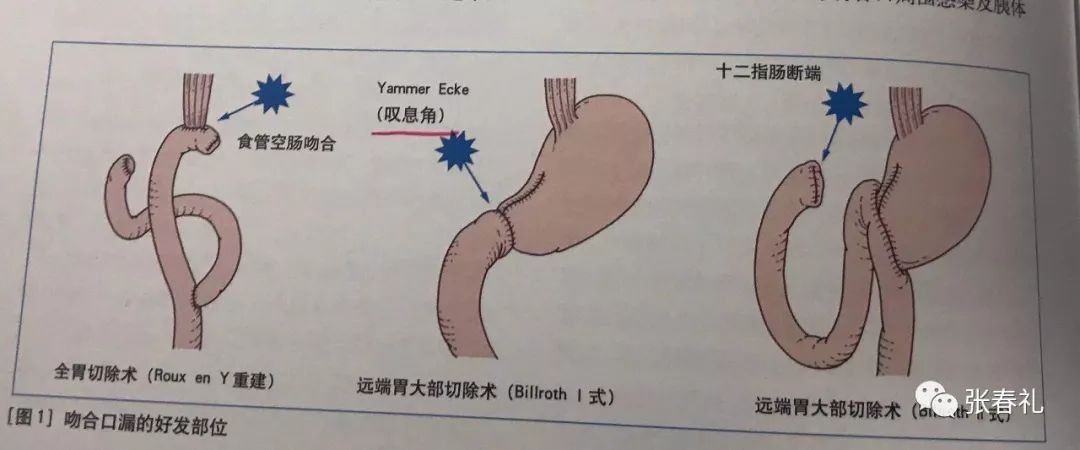 食管空肠吻合术图片