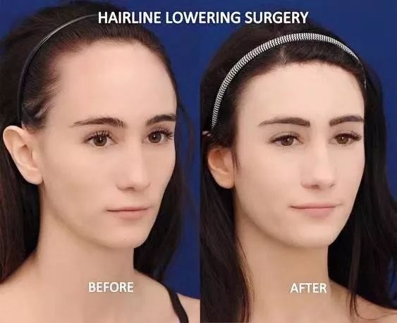 植发前后的颜值对比,看这张图就明白了