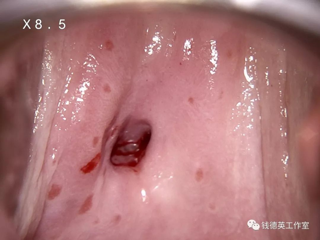 涂醋酸后进一步观察:宫颈表面散在弥散分布红色充血斑阴道镜所见:涂