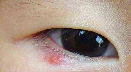 被螨虫咬伤后的皮疹为红色丘疹,丘疱疹,水疱或丘疹性荨麻疹样损害