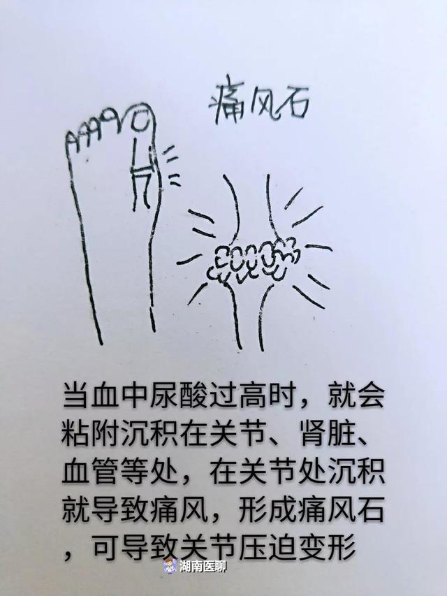 尿酸就会以尿酸盐结晶形式沉积于关节,肾脏,形成关节内外痛风石,尿酸