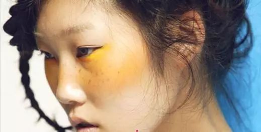 3,颗粒层——皮肤暗哑,肤色暗沉,面色晦暗,色素沉,对光反应能力下降