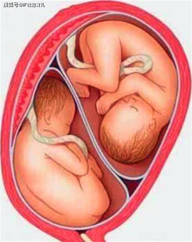 3张 一个孕囊俩胚芽,孕妈喜怀双胞胎,三种双胞胎形式你了解几个?
