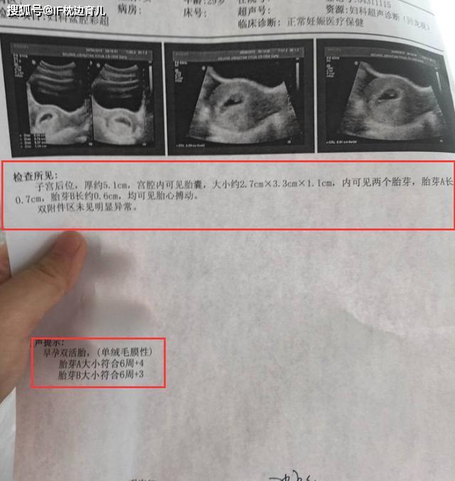 怀孕35天胎儿图片 真实图片