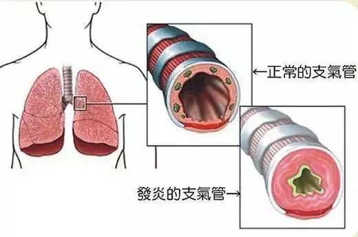 1,易发心脏病由于肺郁血而引起的咳嗽,常为干咳,痰量不多.