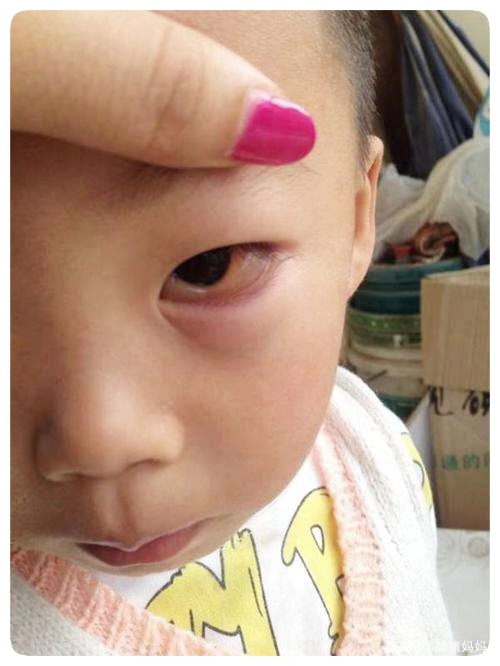 5岁儿子被辣椒辣到眼睛孩子哭不停妈妈的做法获医生夸赞