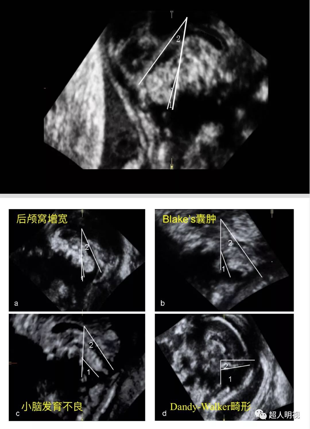 小脑蚓部超声图片图片